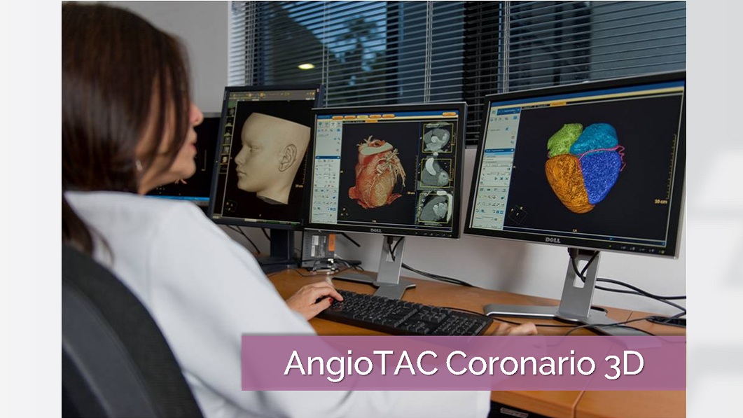 AngioTAC coronario IDACA 3D Blog